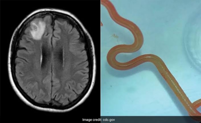 Live worm found in woman’s brain in world-first discovery